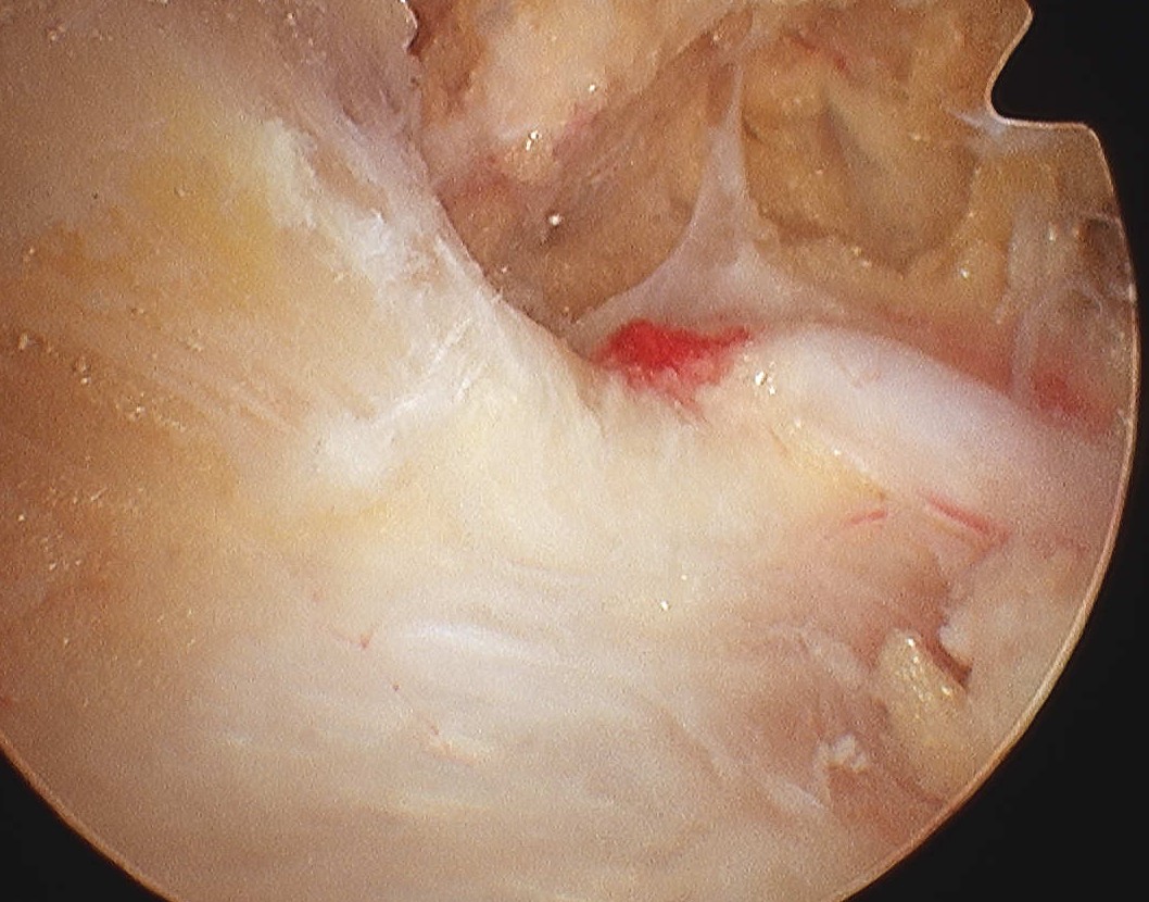Conoid Ligament SSA over THL